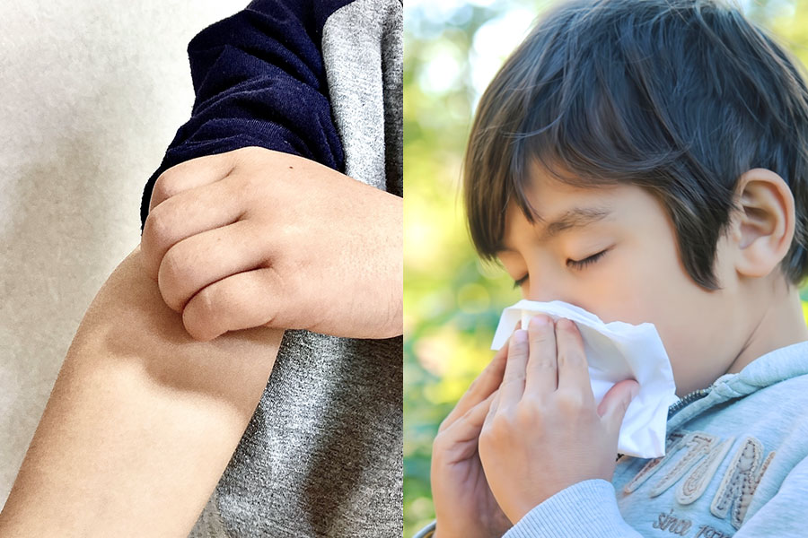 アレルギー科について